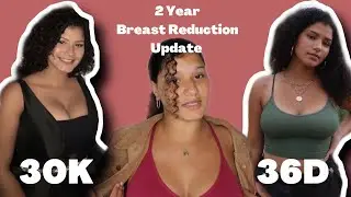 2 Year Breast Reduction Update!| Was It Worth It?