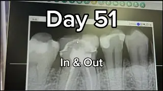 Day 51 | Appalachian Trail 2024 | Adventure Therapy