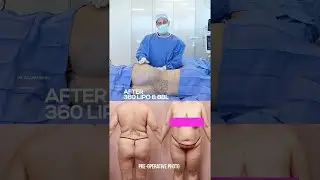 BEFORE & AFTER | 360 Liposuction and Brazilian Butt Lift (BBL)
