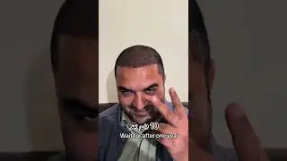 Hair transplant 1 year Result #hairstyle #hairtransplant #shorts