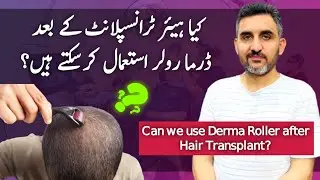 Can We Use Derma Roller After Hair Transplant? | Dr. Habib