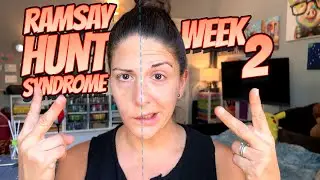 My Ramsay Hunt Syndrome Journey - Week 2