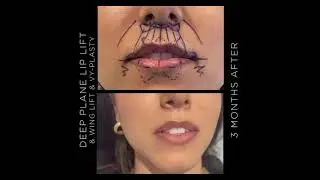 Deep Plane Lip Lift - Before & After | #shorts