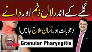 Granular Pharyngitis: Causes, Symptoms & Easy Treatment | Throat Redness and Pain Explained
