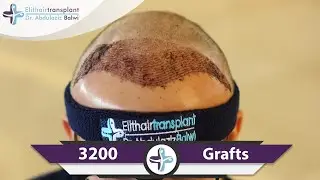 FUE hair transplant
