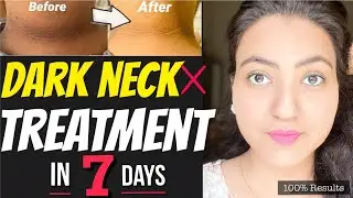 1 WEEK CHALLENGE 💕: Get Rid of DARK NECK गर्दन के कालेपन  DARK ELBOW KNEE एड़ी In Just 7 Days