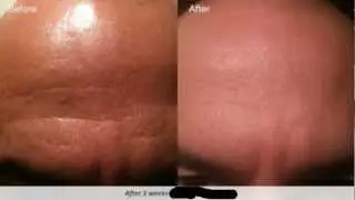 deep forehead wrinkles men