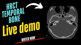 CT Scan Temporal Bone Complete Explanantion, TEMPORAL BONE ANATOMY,FILMING ,COMPARISION, PATHOLOGY