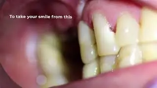 BEFORE AND AFTER DENTAL IMPLANT, GET YOUR DREAM SMILE! | ANGELA LEUNG DDS PC