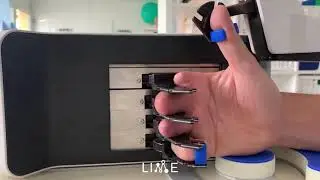 Application of AnyHand - patient with amputated fingers