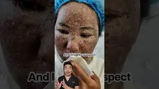 Отшелушивающие маски на самом деле не удаляют черные точки.