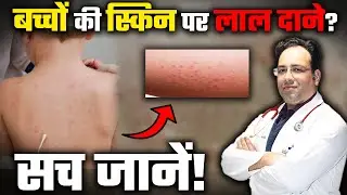 URTICARIA & HIVES - Causes and Treatment of Itchy Skin Rash | बच्चों की स्किन पर लाल दाने?