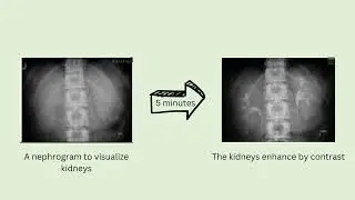 IVU PROCEDURE FOR HORSESHOE KIDNEY
