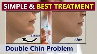 Double-Chin Reduction (Tamil)|| Injection to remove Fat  -Dr.C Senthil Kumar