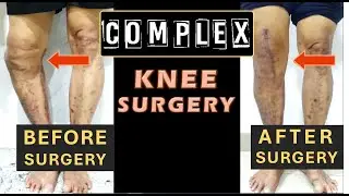Unhealed Fracture with Arthritis - Complex Knee Replacement, Hinge Implant, Chennai, India