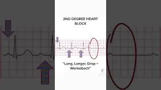 2nd Degree Heart Block