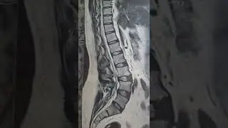 #выпячивание межпозвоночного диска #