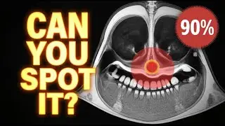 Stop Missing Sinusitis Questions: USMLE High Yield Quiz