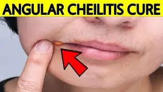 How to Get Rid of Angular Cheilitis at Home Naturally & FAST