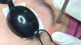 NSC Eyebrow Laser hair Removal