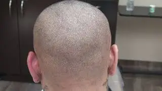 Dr. Diep Reviews Scar FUE Scars Hair Transplant Restoration Surgery Minimal Scar Bald Hair Loss