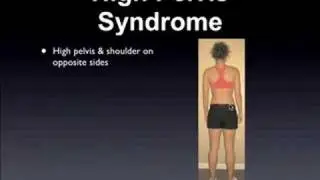 4 Conditions Responsible For Sciatica & Back Pain