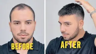 KISA PROTEZ SA&Ccedil; MODELİ - HAIR REPLACEMENT