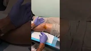 Knee Fluid Removal: Painless