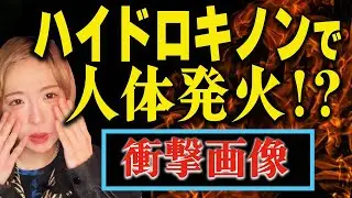 【衝撃画像】ハイドロキノンの使い方を間違えて一生後悔した話