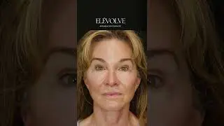 Achieving a more natural and youthful look with EL&Eacute;VOLVE!
