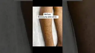 Dry skin & dark spots Removal Result By Biobeauty skin clinic #skinclinic #dryskin #peels #srilanka