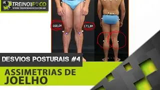Assimetrias de Joelho - Desvios Posturais #4