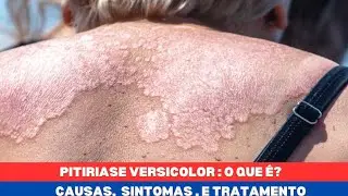 PITIRIASE VERSICOLOR: O QUE &Eacute;? CAUSAS, SINTOMAS, E TRATAMENTO