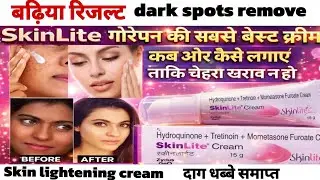 Skin Lite Cream Review | Pigmentation & Dark Spots Treatment | Daag Dhabbe Hindi #skin #skincare 