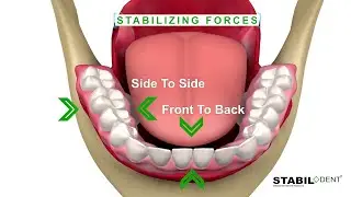 How Lower Denture Stabilizers Work-Denture Adhesive Alternative