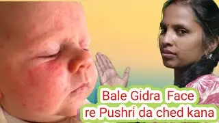 Bale Gidra Menhaw re Cheda Pushri Odok Ah??FAce Acne For Newborn Baby.//Santhali Informative video//