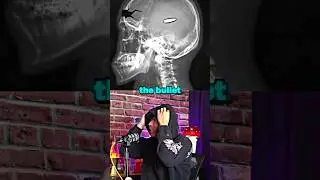 He Survived A Bullet To The Head 🤯