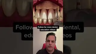Shaving the jawbone for this🤯!#jaw#Dentistry #Gum #Shorts