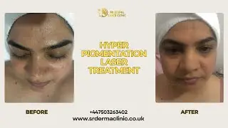 Hyperpigmentation Laser Treatment: Real Patient Before & After | SR DERMA LASER CLINIC
