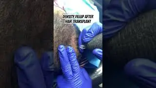 Scalp micropigmentation for  density buildup after hair transplant #scalpmicropigmentation #smp