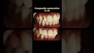 Composite filling in 12(Ignore the yellow fluorosis stain😅)#learnbdswithme #dentistry #composite#bds