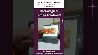 Rectovaginal Fistula Treatment Successful