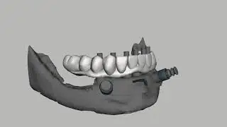 Pr&oacute;tesis h&iacute;brida sobre 6 implantes! Meshmixer and blueskyplan