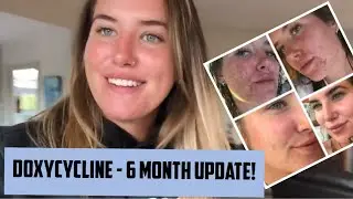DOXYCYCLINE - 6 month update! ACNE JOURNEY