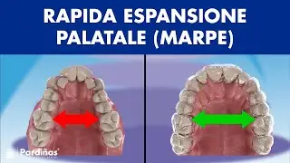 ESPANSIONE rapida del PALATO (MARPE) negli adulti ©