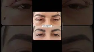 &Uuml;st G&ouml;z Kapağı Ameliyatı, Upper Eyelid Surgery