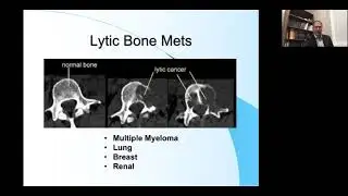 Metastatic Bone Disease  Current Treatment Options