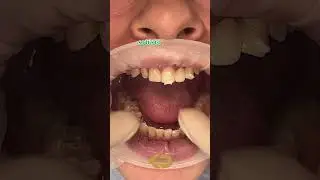 The Difference Between Veneers, Crowns, & Implants 🦷 #veneers #crowns #implants #difference