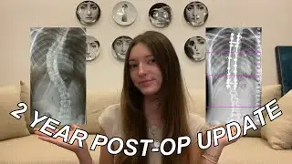 Обновление за 2 года после операции по спондилодезу! | Вопросы и ответы + обновление о восстановл...