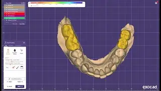 Lower right & left molar designing in exocad for pmma prosthesis